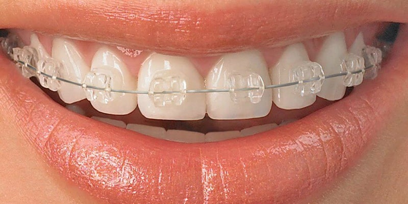 مزایای ارتودنسی مخفی دندان