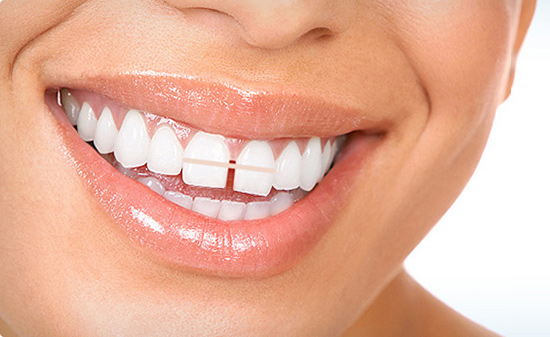 روش های بستن فاصله دندانی