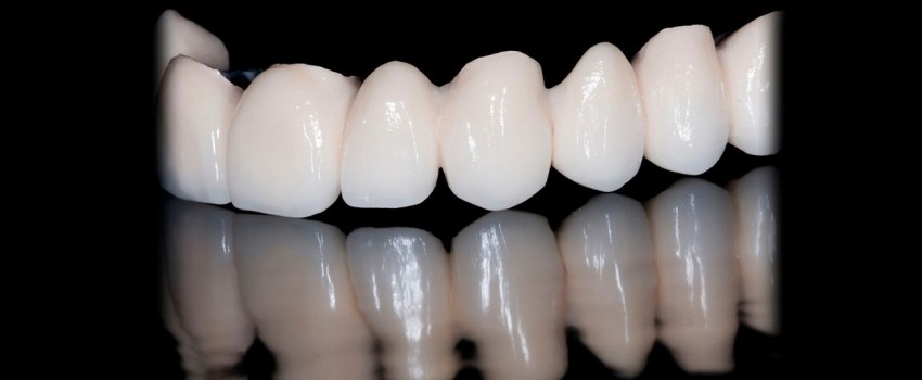 کاربردهای روکش دندان از جنس سرامیک